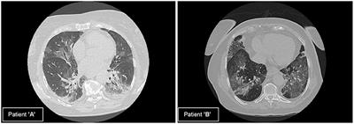 Differentiating Phenotypes of Coronavirus Disease-2019 Pneumonia by Electric Impedance Tomography